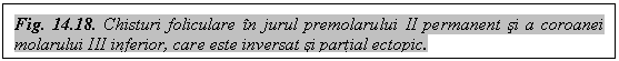 Text Box: Fig. 14.18. Chisturi foliculare in jurul premolarului II permanent si a coroanei molarului III inferior, care este inversat si partial ectopic.