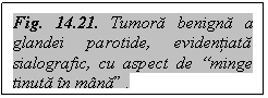 Text Box: Fig. 14.21. Tumora benigna a glandei parotide, evidentiata sialografic, cu aspect de