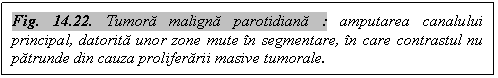 Text Box: Fig. 14.22. Tumora maligna parotidiana : amputarea canalului principal, datorita unor zone mute in segmentare, in care contrastul nu patrunde din cauza proliferarii masive tumorale.